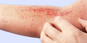 Atopic Dermatitis: Pathways to Personalized and Long-Term Care