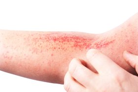 Atopic Dermatitis: Pathways to Personalized and Long-Term Care