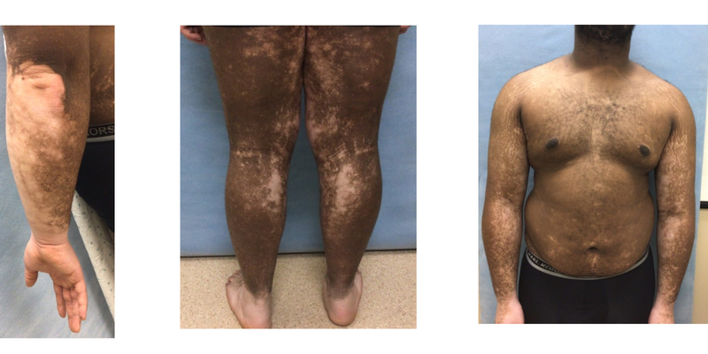 Case Image - Recognizing and Treating Unstable Vitiligo V2