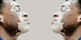 Cover Photo - Conventional Therapeutic Approaches in Vitiligo