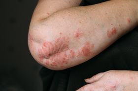 Integrative Approaches in Psoriasis Care: Integrating Lifestyle and Psychosocial Support