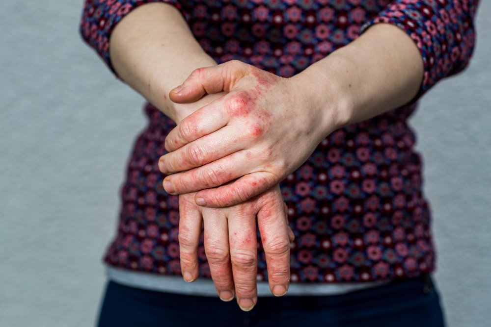 Article: Chronic Hand Eczema