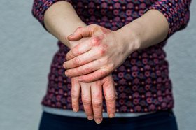 Article: Chronic Hand Eczema