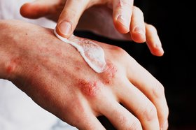 Hand Eczema