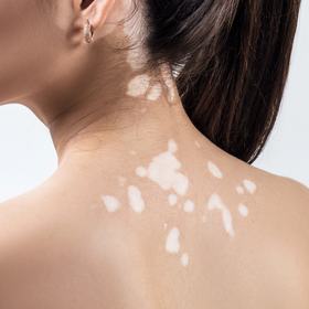Vitiligo: Achieving and Maintaining Repigmentation