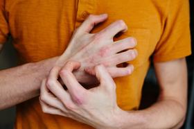 EBGLYSS®(lebrikizumab-lbkz): What could less mean for your patients? - Image