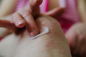 Optimizing Psoriasis Treatment Strategies