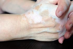 Upadacitinib in Nonsegmental Vitiligo: Results of Two Phase 3 Randomized Controlled Studies (Viti-Up)