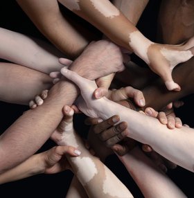 Optimizing Clinical Decision-Making and Competence in JAK Inhibitor Therapy for Vitiligo