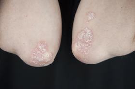 Connecting Skin and Joint: Clinical Conversations on Psoriasis and Psoriatic Arthritis Co-Management