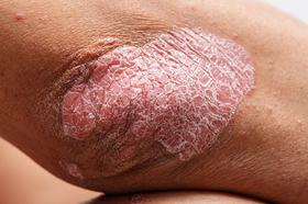 Comorbidities and Integrative Care in Psoriasis