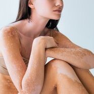 vitiligo cropted