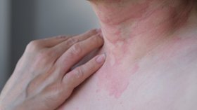 Chronic Spontaneous Urticaria