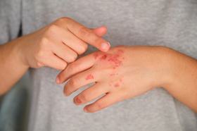 Challenging Assumptions: Clarifying Type 2 Inflammation Across AD, CSU, and PN