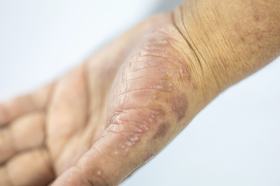 Expanding the Story in Moderate AD Patients With Higher Disease Severity