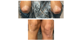 Exploring Treatment Options in a Patient with Hypothyroidism & Vitiligo - Cover Image