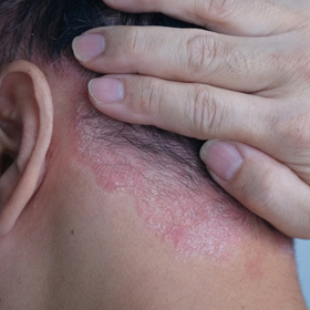 Practical Approaches to Psoriasis Management: Enhancing Clinical Practice and Patient Engagement