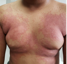 Clinical Management Considerations in Pediatric Psoriasis