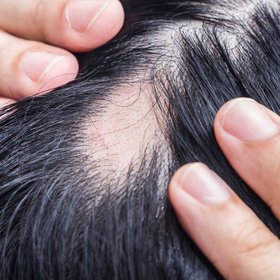 Modern Management of Alopecia Areata Innovation Meets Compassion