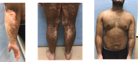 Recognizing and Treating Unstable Vitiligo