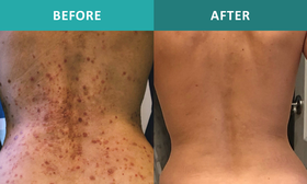 Optimizing Psoriasis Management: Integrating Clinical Outcomes with Patient Priorities