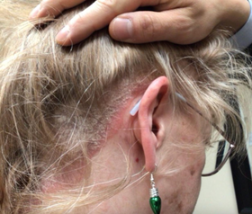 Managing a Patient with Scalp Psoriasis Course Image