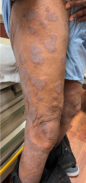 Dietary Interventions to Consider in a Dermatology Patient taking a Biologic