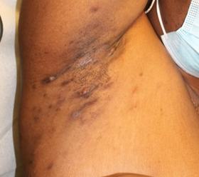 Case-Based Approach to HS Severity Grading & IL-17F Pathogenesis - pic2