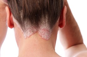 Psoriasis: Evolving Therapies and Whole-Patient Management