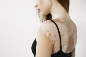 Topical Therapies for Vitiligo