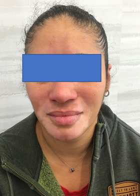 Treating Facial Vitiligo in a 32-Year-Old Female