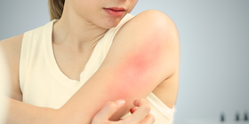 Update on Itch: Emerging Integrative Insights and Therapeutic Advances