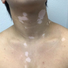 Vitiligo Case simulation#1