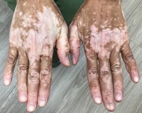 Assessing Disease Activity in a 54-Year-Old Woman With Vitiligo