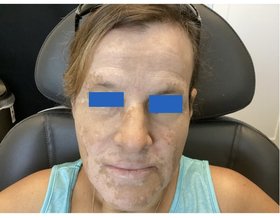 Optimizing Treatment for Progressive Vitiligo - Case Study Image