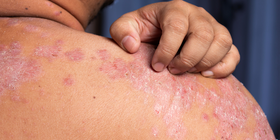 Integrative Approaches in Psoriasis: Combining Pharmacologic and Lifestyle Interventions 1